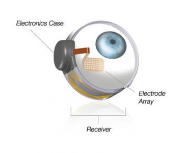 first retinal implant