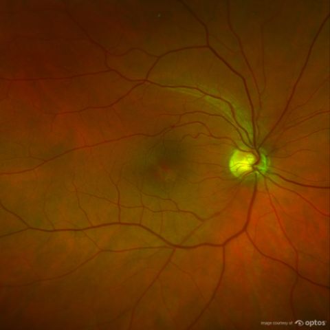 AAO eye disease databased
